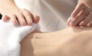 fertility-acupuncture