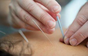 Acupuncture-and-Its-Benefits