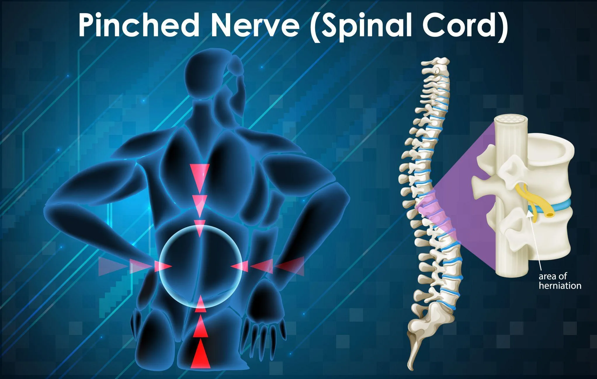 Pinched-Nerve-Spinal-Stenosis