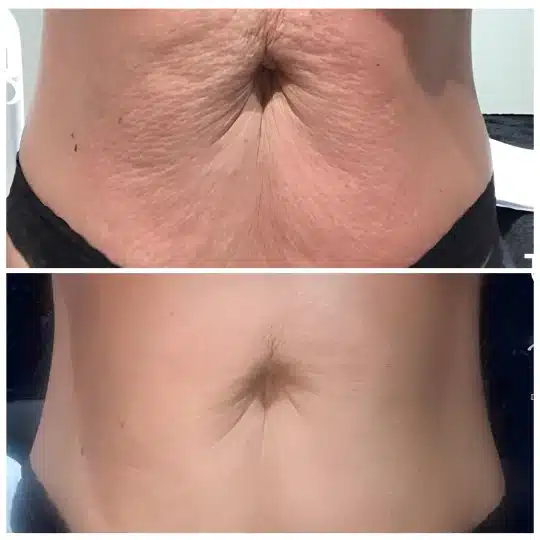 t-shape2-before-after-1-1