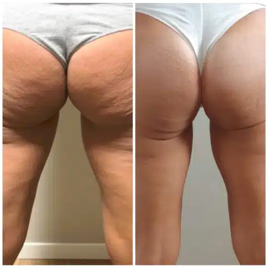 t-shape2-before-after-3-1
